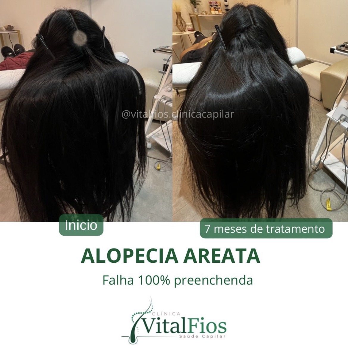 Evolução de alopecia areata acompanhada pela Vital Fios em Botucatu