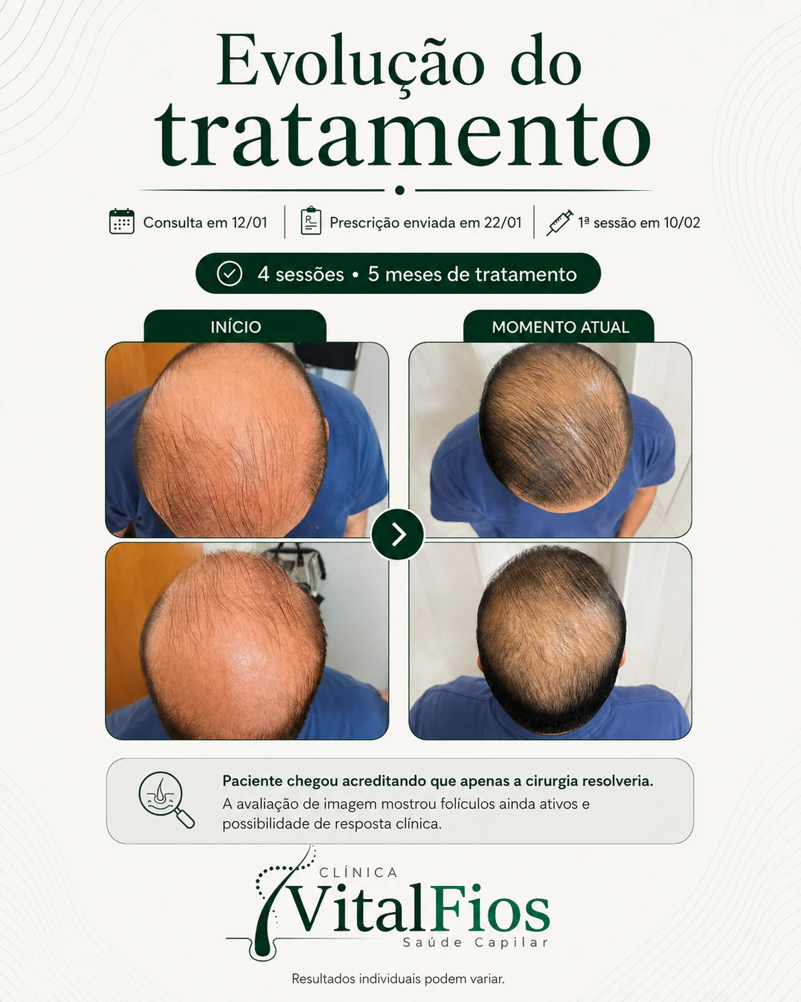 Evolução capilar com 4 sessões realizadas antes de considerar transplante capilar na Vital Fios em Botucatu