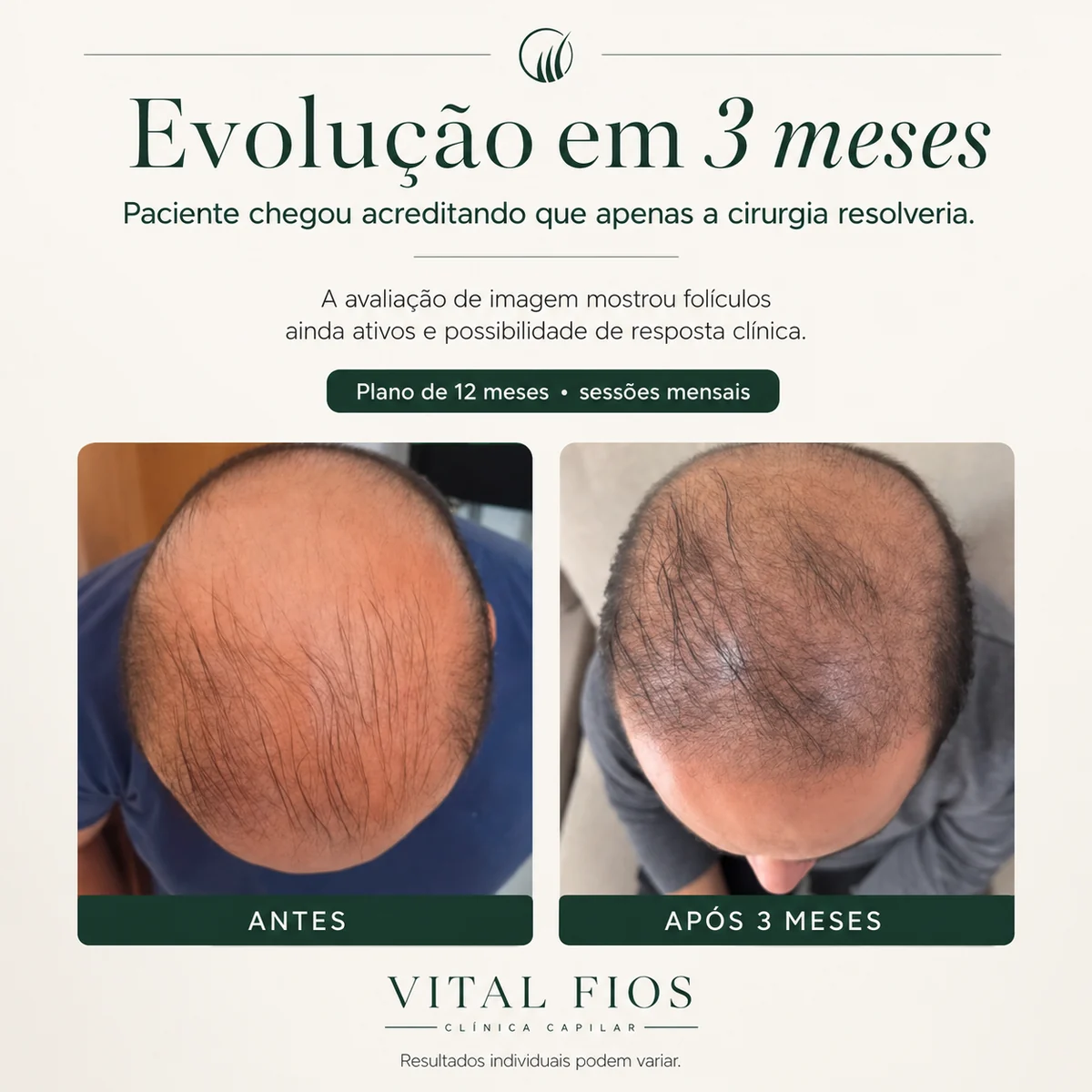 Evolução capilar em 3 meses antes de considerar transplante capilar na Vital Fios em Botucatu