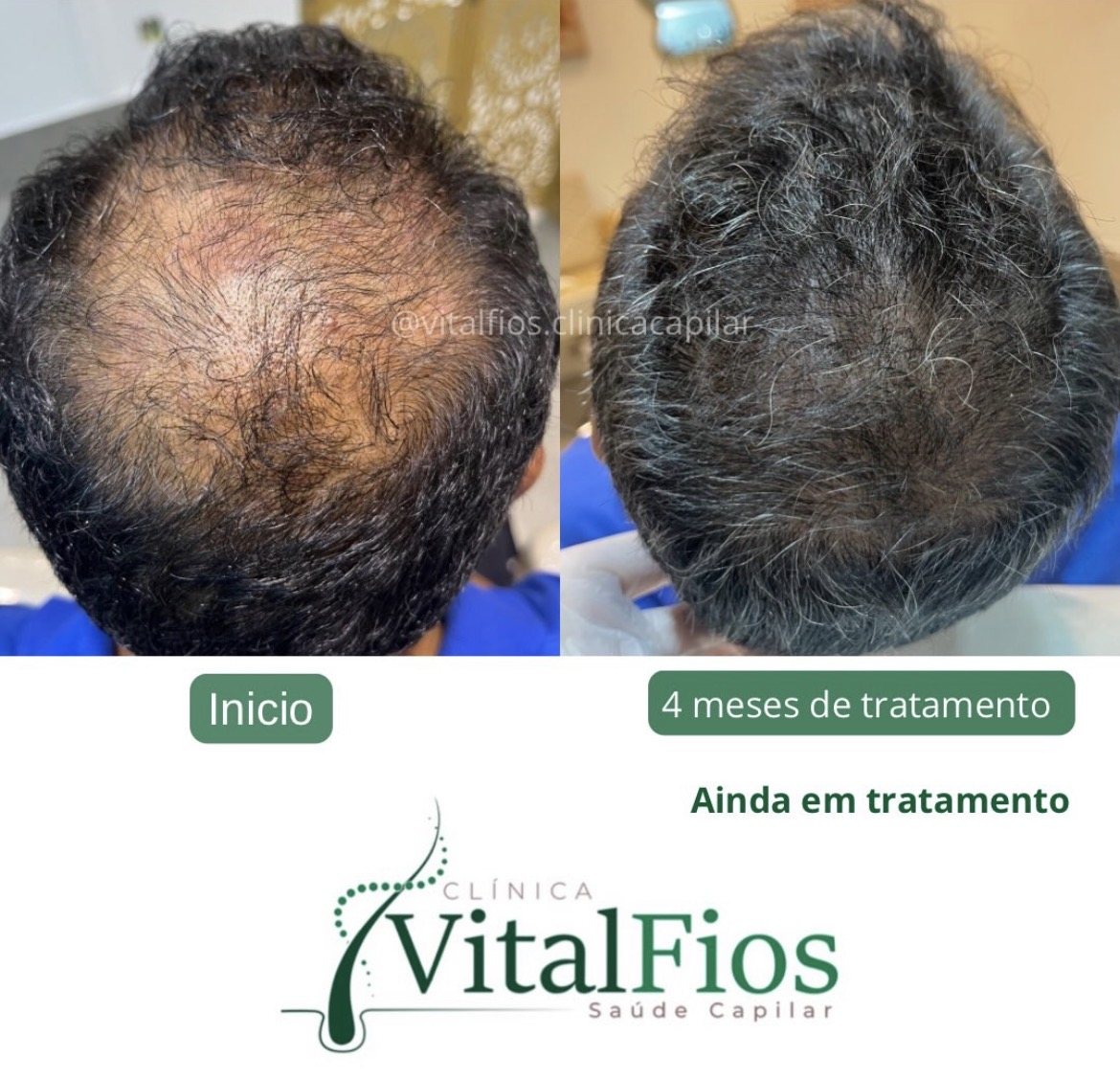 Acompanhamento de queda de cabelo masculina na Vital Fios