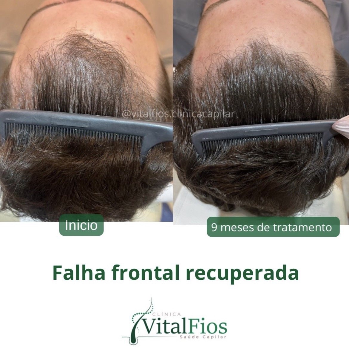 Acompanhamento de falha frontal e calvície na Vital Fios em Botucatu